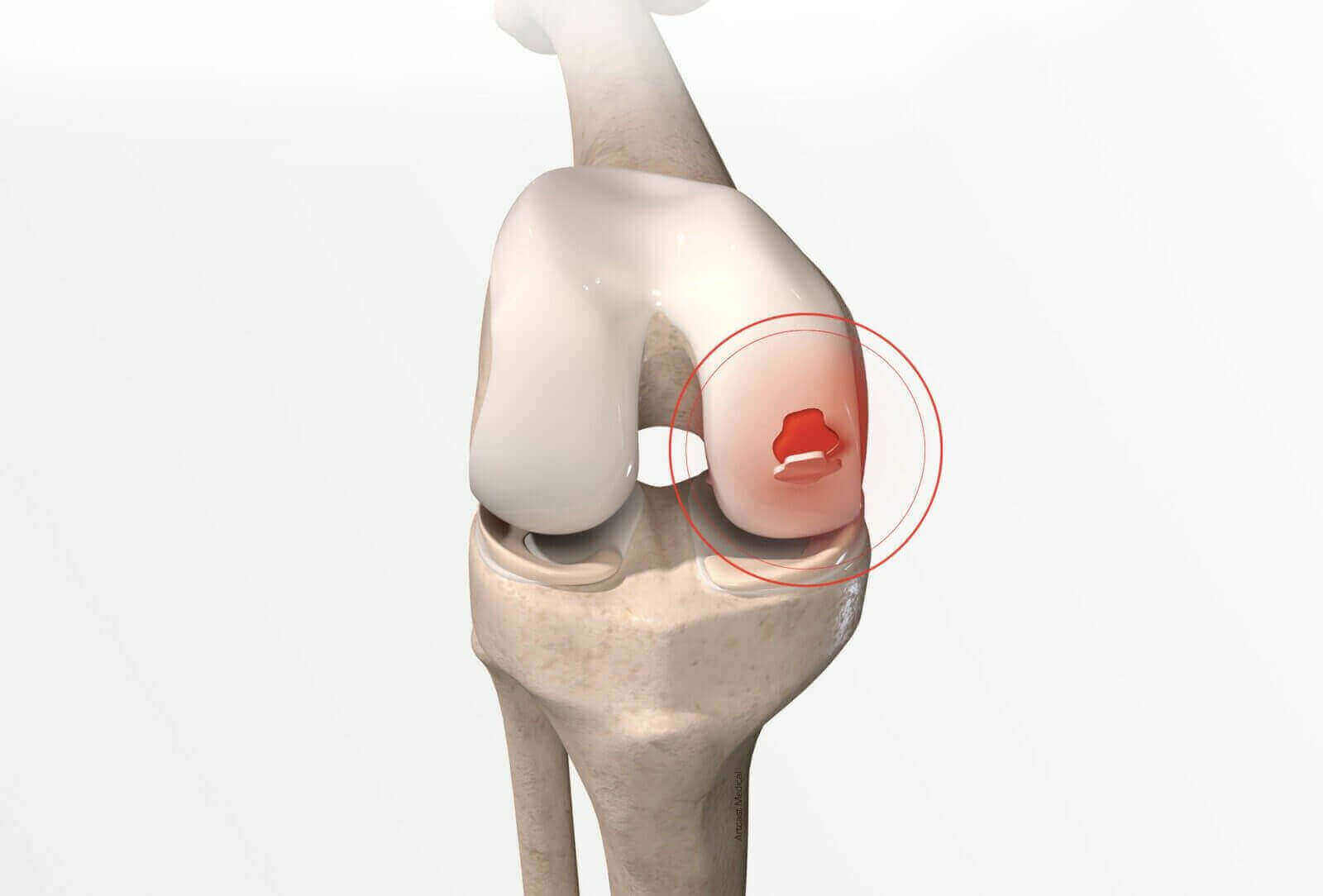 Two-stage Knee Cartilage Transplant Surgery